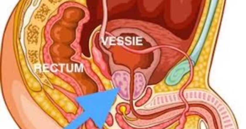 Santé : Voici ce qu&rsquo;il faut faire pour éviter et réduire les risques de cancer de la prostate