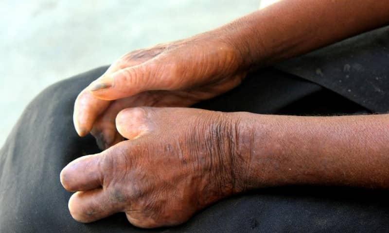 Oicha – Santé : Pénurie de médicaments contraint les lépreux à se faire soigner en Ouganda